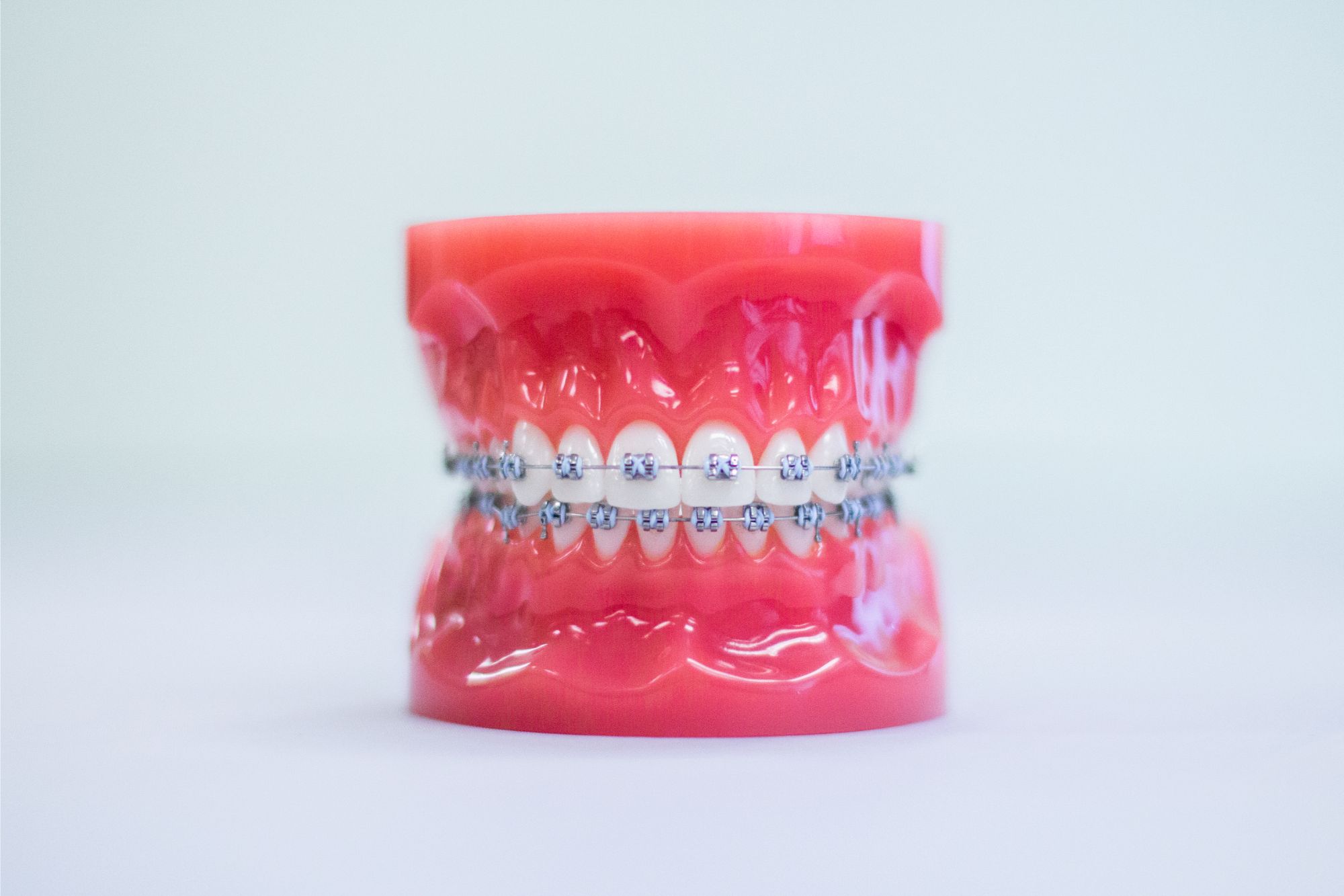 The Role of Spacers and Rubber Bands in Orthodontic Work
